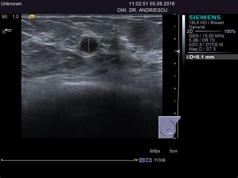 imagini cu fibroadenom cu ecografie mamară